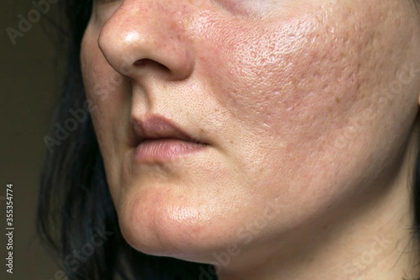 Fototapeta Woman with problematic skin and acne scars. Pigmentation on face woman. Problem skin care and health concept. 
