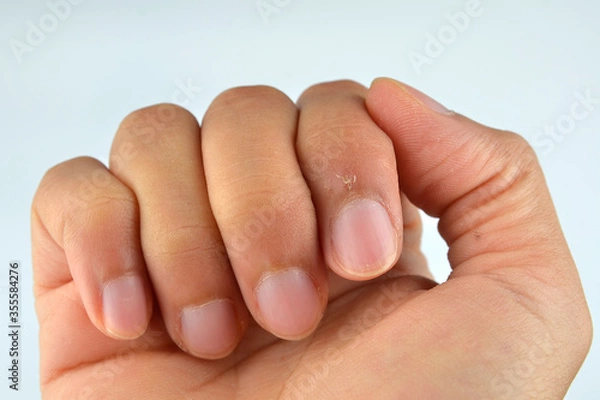 Obraz Finger with hangnail isolated on white background
