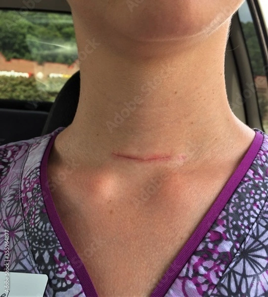 Obraz A healing scar on a woman's neck from thyroidectomy surgery due to papillary thyroid cancer 