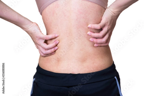 Fototapeta The girl was born with itch after allergies. Skin diseases caused by fungi Then he uses the hand to chamfer the back. White background and clipping path.