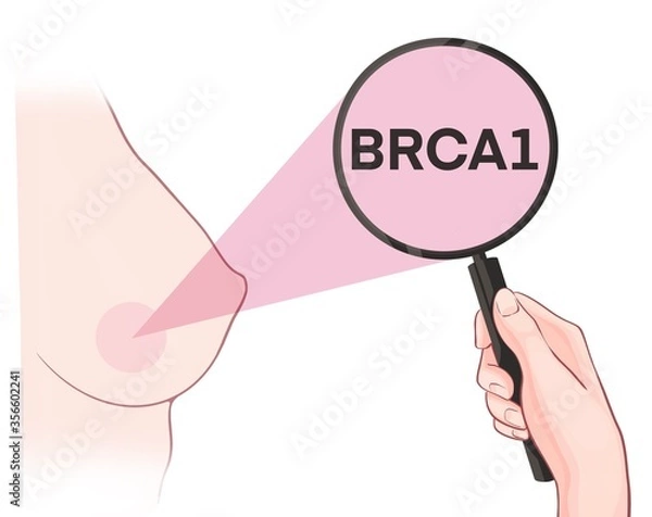 Fototapeta Variants in the BRCA1 gene are associated with an increased risk of developing breast cancer