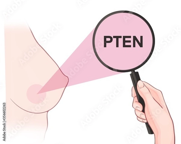 Fototapeta Variants in the PTEN gene are associated with an increased risk of developing breast cancer