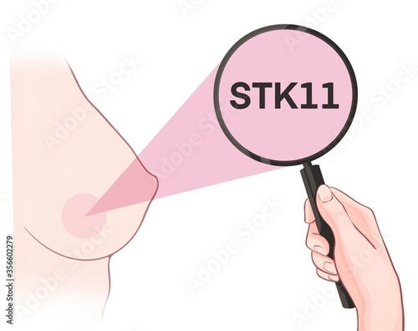 Fototapeta Variants in the STK11 gene are associated with an increased risk of developing breast cancer