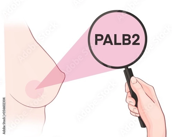 Fototapeta Variants in the PALB2 gene are associated with an increased risk of developing breast cancer
