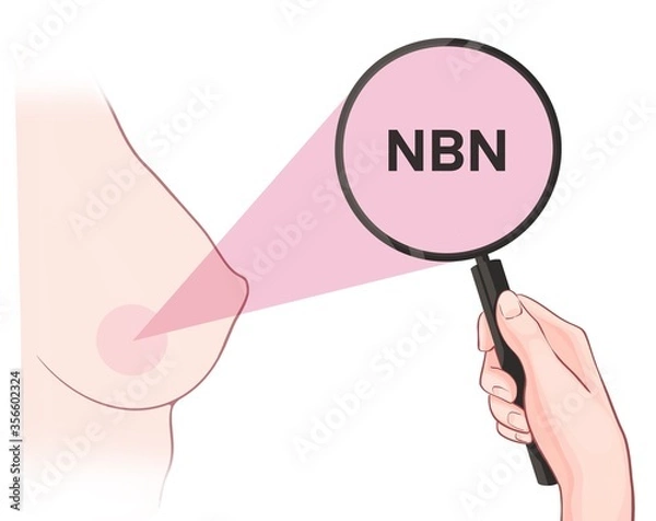 Fototapeta Variants in the NBN gene are associated with an increased risk of developing breast cancer