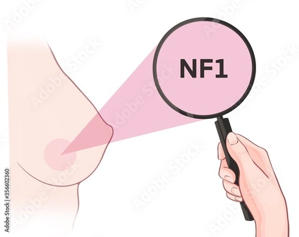 Fototapeta Variants in the NF1 gene are associated with an increased risk of developing breast cancer