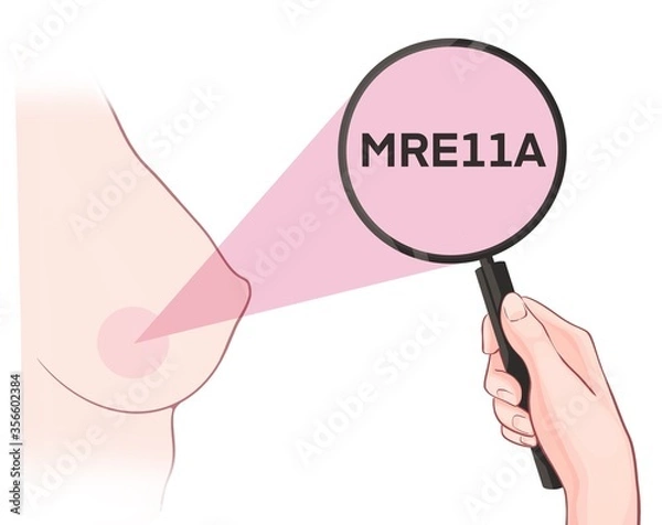 Fototapeta Variants in the MRE11A gene are associated with an increased risk of developing breast cancer