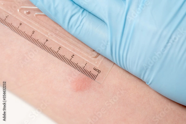 Fototapeta Closeup view photography of child's hand with red spot reaction to conducting Mantoux test after 72 hours from injection. Nurse in blue gloves applying transparent ruler to check reaction.