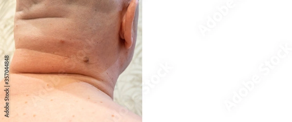 Obraz men's back in moles, doctor's examination photo. banner mock up, empty place for text.