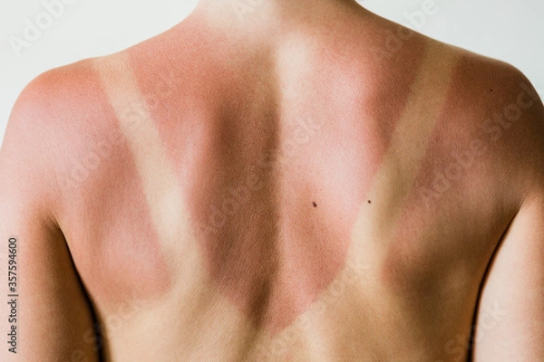 Fototapeta Close-up of a sunburn marks on a woman's back