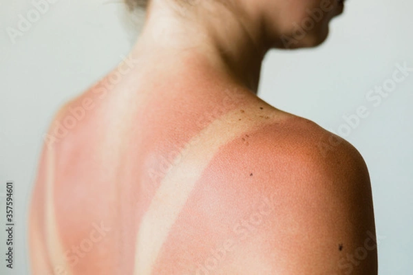 Fototapeta Close-up of a sunburn marks on a woman's back