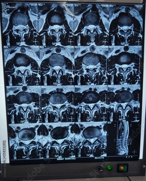 Obraz CT scan Section of a lumbar vertebrae 