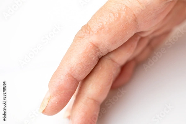 Fototapeta Close up Atopic dermatitis on finger(AD), also known as Atopic eczema.Skin disease concept.