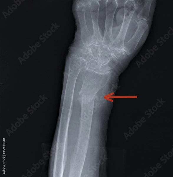 Fototapeta radius fracture on the x-ray of the forearm