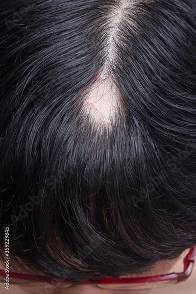 Fototapeta Alopecia Areata - Spot Baldness is a condition in which hair is lost from some or all areas of the body.