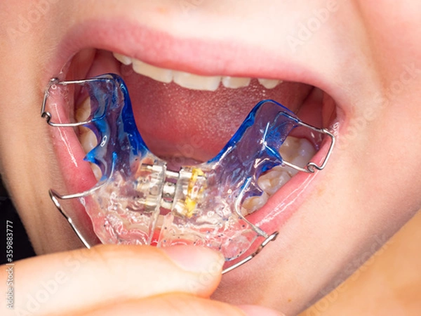 Fototapeta Patient photo of teeth with orthodontic braces.