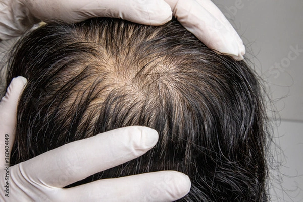 Fototapeta Asian man age 40-50 years worried with hair loss problem. He visit dermatologist for his hair fall problem. Checking and treatment concept.