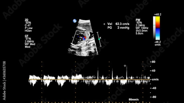 Fototapeta Ultrasound screen with fetal echocardiography