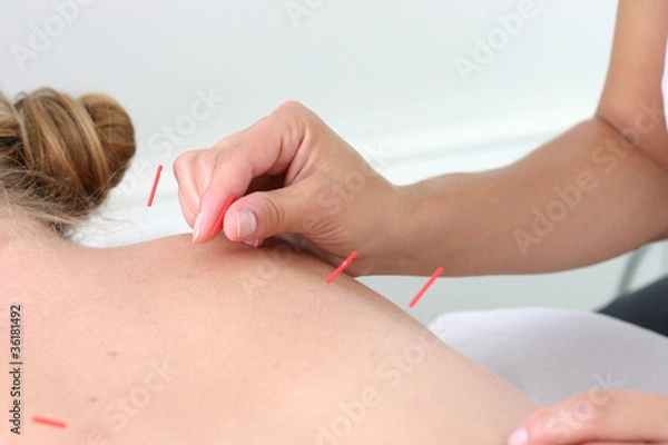 Obraz acupuncture needles