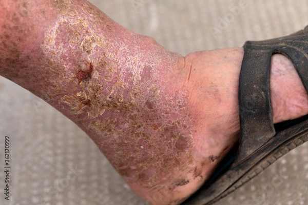 Obraz Foot ulcer