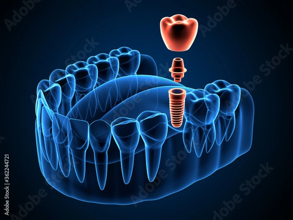 Obraz 3d render rentgenowskie szczęki z umieszczeniem implantu dentystycznego