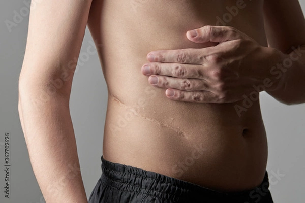 Fototapeta male perosn showing surgery scar after kidney pyelonephritis. after remove kidney operation. caucasian person close up over grey background.