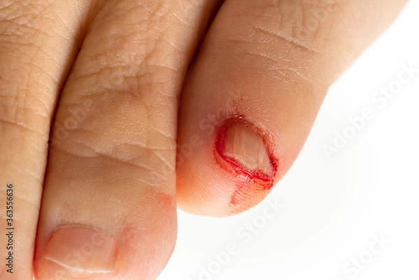 Fototapeta 足の小指の怪我で出血