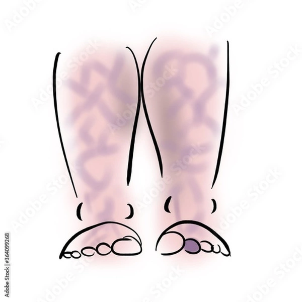 Obraz Livedo reticularis and blue finger