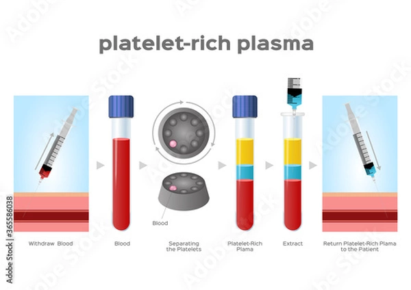 Fototapeta Platelet-Rich plasma procedure stages / prp / Centrifuge vector