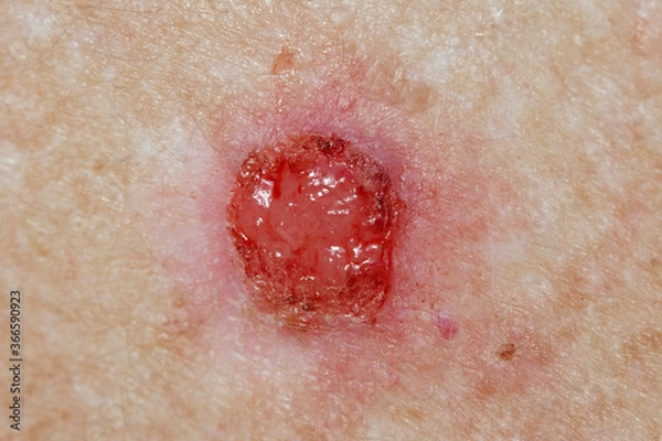 Obraz Basal Cell pre-treatment - sore open wound with constant weeping and bleeding. 