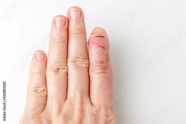 Fototapeta part of palm with cut index finger with a extensor tendon injury, mallet finger, tip of the finger bending downwards other fingers stay straight, deformity in the last phalangeal bone, digit hurt
