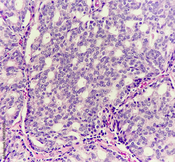 Fototapeta Photo of prostate cancer displays Gleason pattern 4, photo under light microscope, magnification 200x