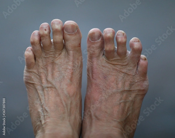 Obraz Aging human bare foot with veins