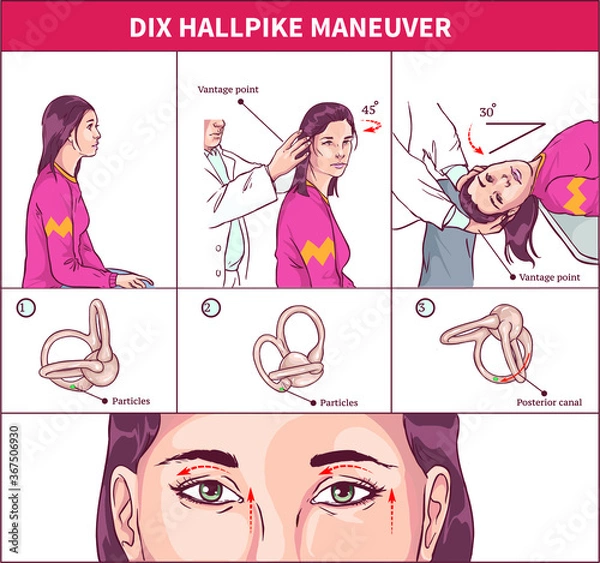 Obraz Dix Hallpike Maneuver Vector  illustration
