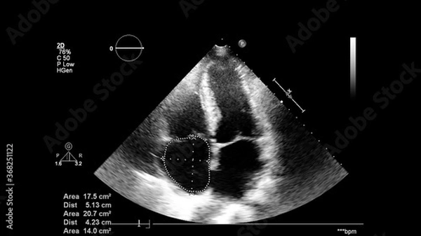 Fototapeta Image of the heart in gray-scale mode during transesophageal ultrasound.