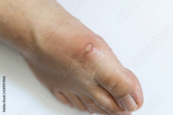 Obraz lesion at foot