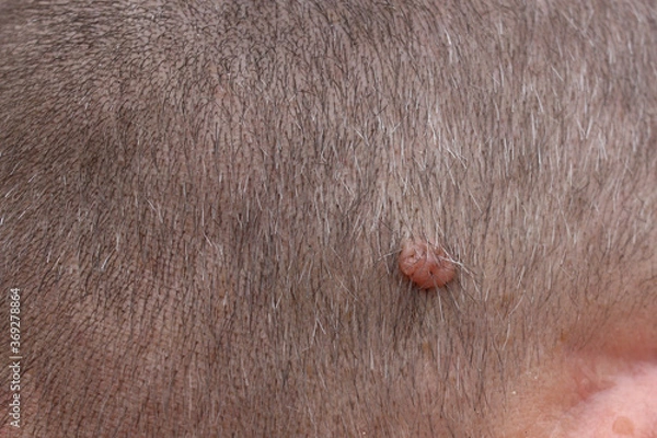 Obraz A neoplasm on the scalp of a man. (Papilloma, condyloma, melanoma, wart).  Selective focus,  Healthcare concept.