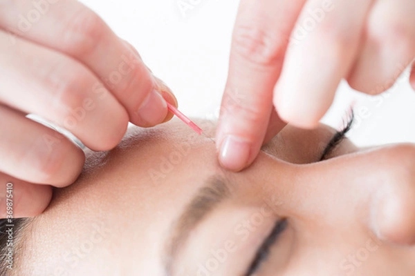 Fototapeta 鍼治療イメージ