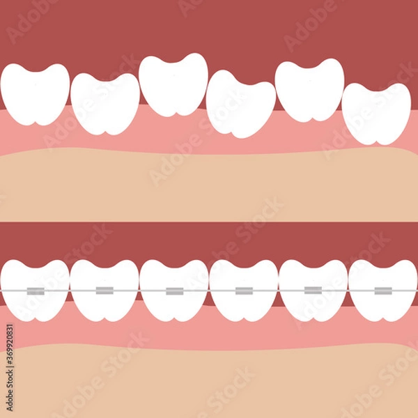Fototapeta The teeth in braces in the gums in the mouth are healthy