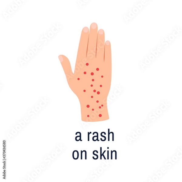 Fototapeta Skin rash icon isolated on white background. Color flat hand palm with allergy eczema psoriasis dermatitis disease symptom sign. Skin condition design. Cartoon dermatology medicine vector illustration