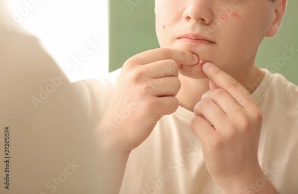 Fototapeta Teenage boy with acne squishing pimples near mirror