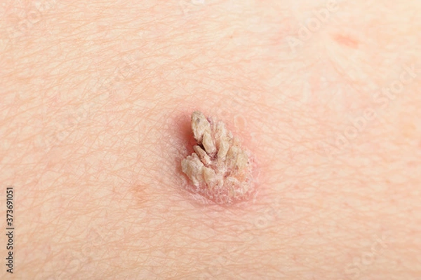 Obraz Heraustretende Papulae bei Warze Verruca vulgares