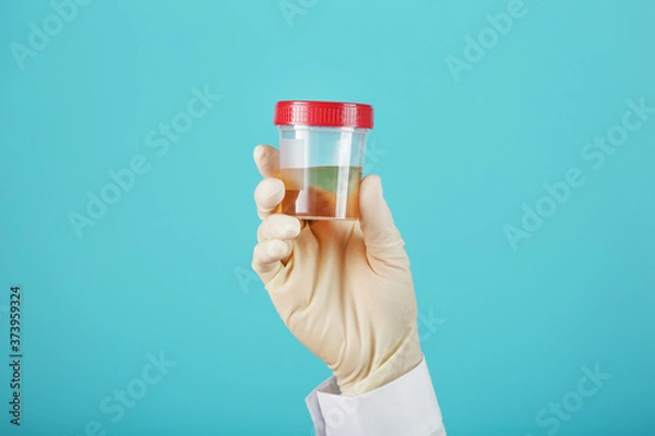 Fototapeta A container for biomaterial with a urine analysis in the hand of a doctor in a white rubber glove on a cyanic background.