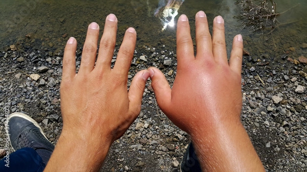 Fototapeta Swollen hand. Allergy to bee stings. Two hands of a person