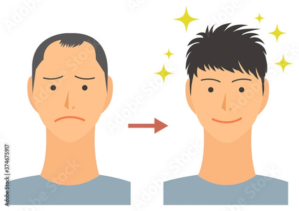 Obraz AGA治療をした男性のイラスト　ハゲ頭　ベクター素材