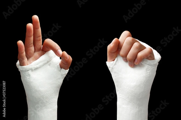 Obraz Broken arm - 05