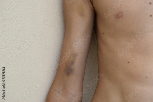 Fototapeta Large bruises and abrasions on the boy's arm.