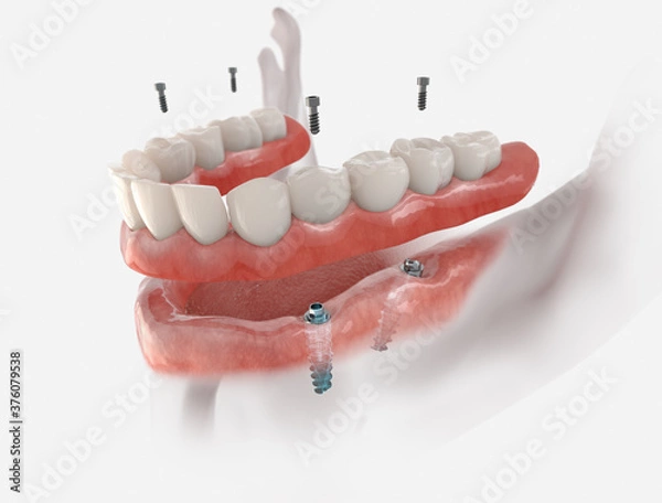 Fototapeta Mandibular fixed restoration with 4 implants, posterior are tilted.  3d illustration of implant on white background. Dental prosthetic innovation.