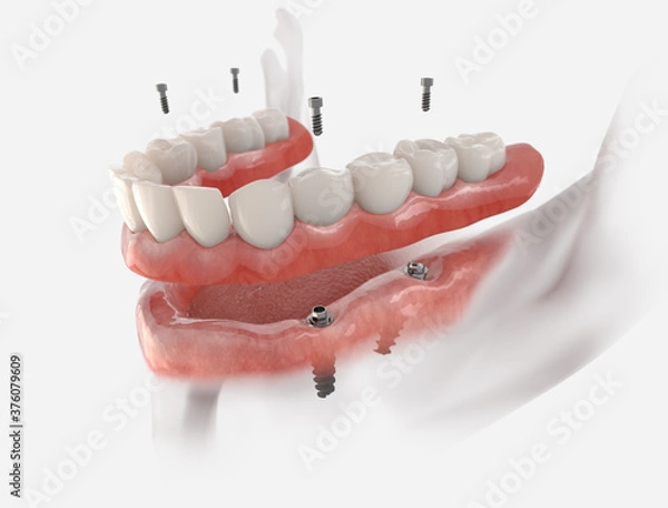 Fototapeta Mandibular fixed restoration with 4 implants, posterior are tilted.  3d illustration of implant on white background. Dental prosthetic innovation.