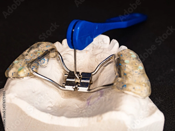 Fototapeta Dentist test setting of palatal braces for young patient